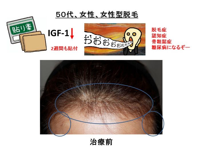 円形脱毛症　病院